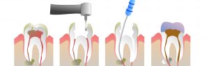 Why And When Is A Root Canal Treatment Performed?